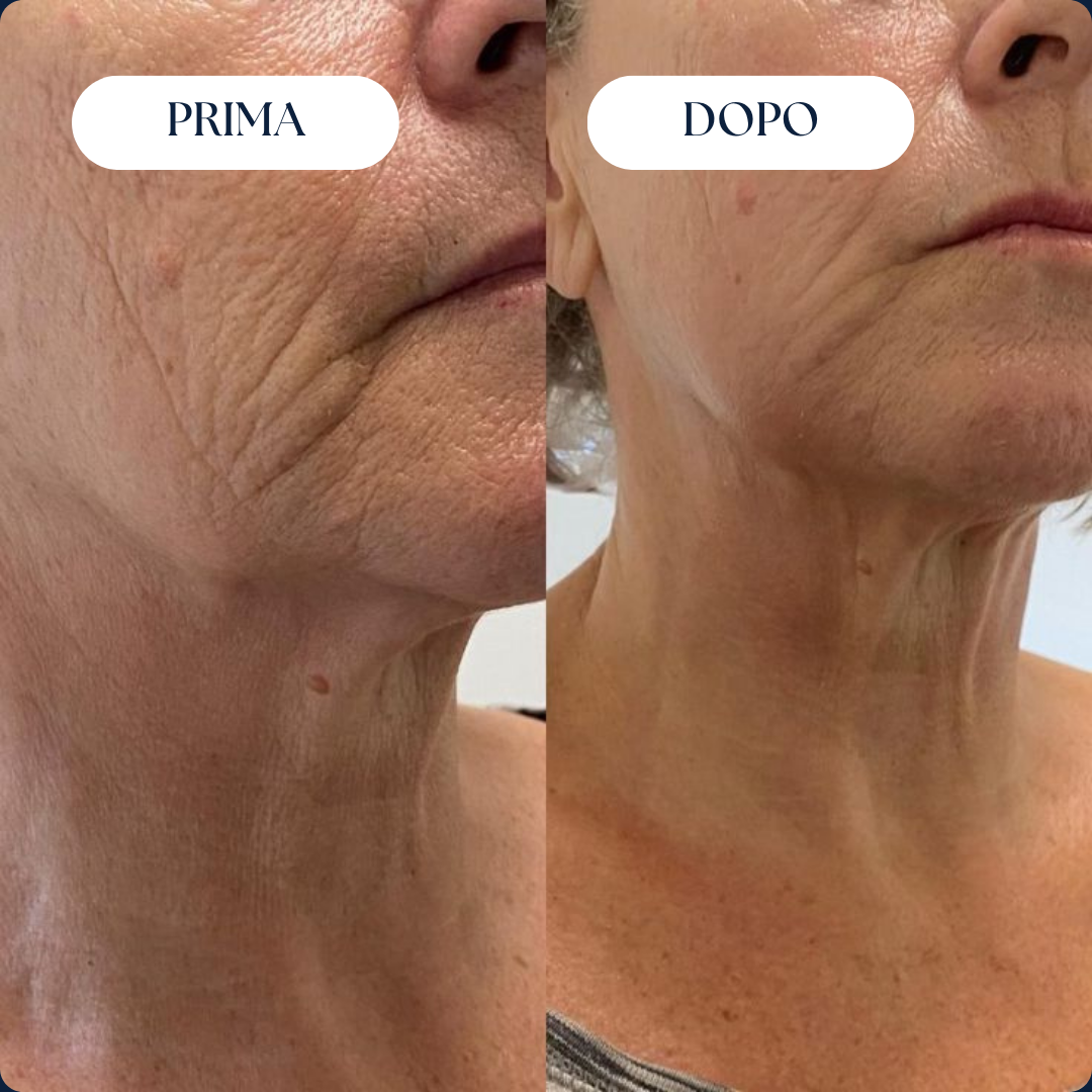 Nairè™ Micro-Needling Esosomi Vegetali