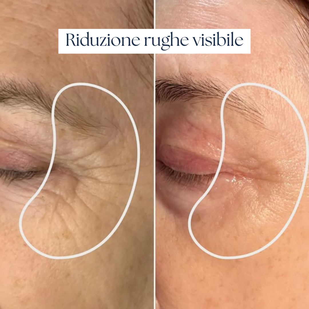 Nairè™ Micro-Needling Esosomi Vegetali