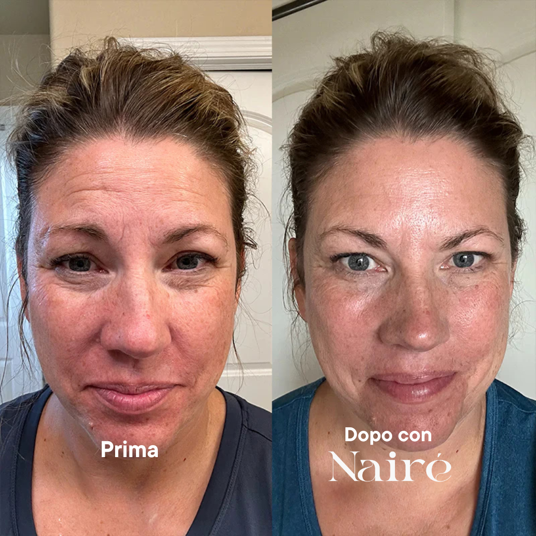 Nairè™ Micro-Needling Esosomi Vegetali