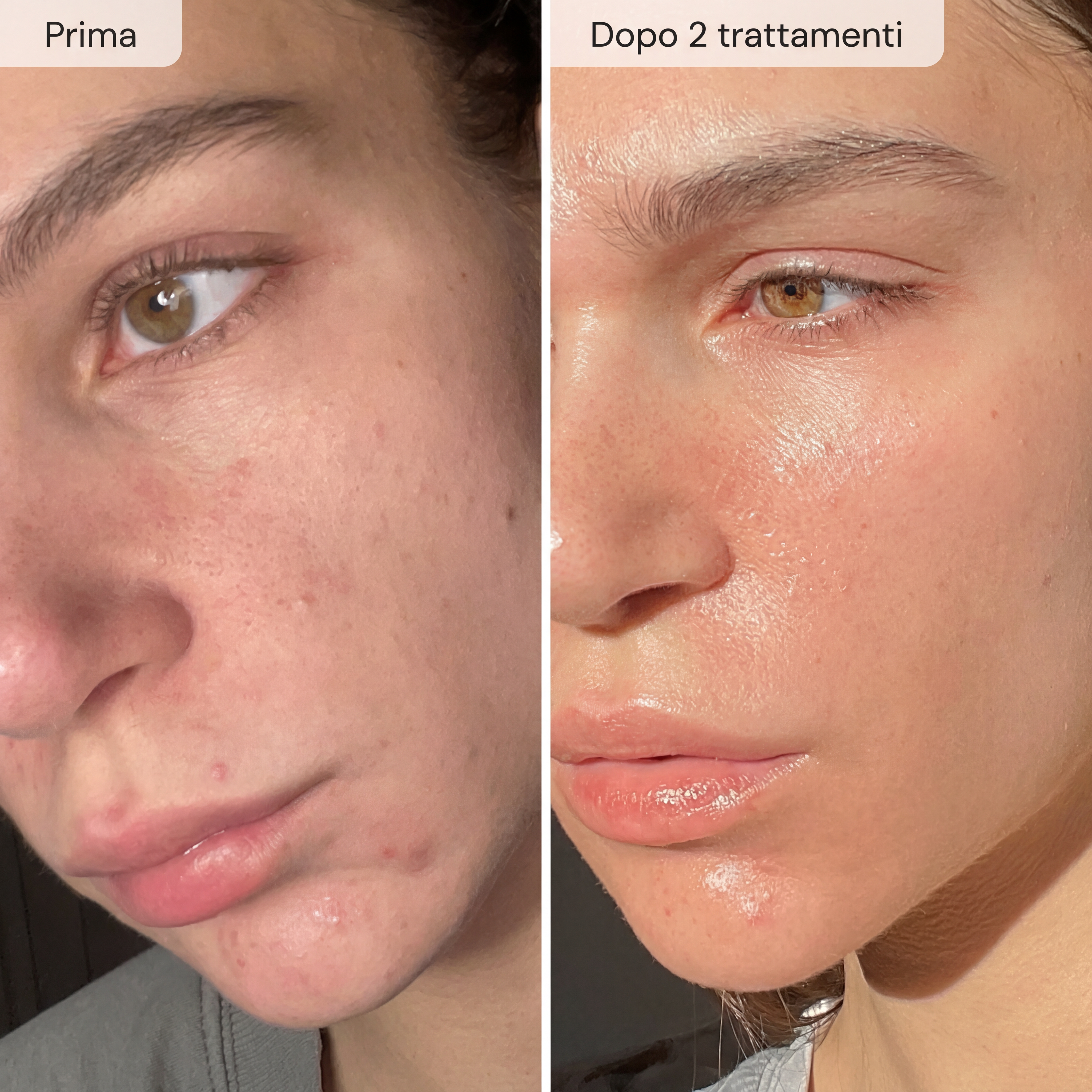 Nairè™ Micro-Needling Esosomi Vegetali